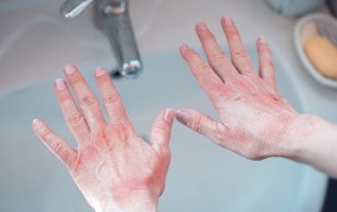 Как распознать у себя аллергию: ответ врача