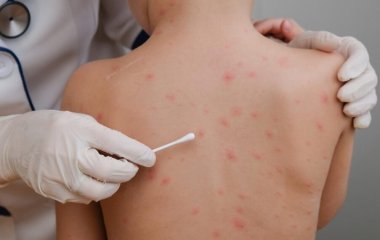 Пищевая аллергия: медики назвали симптомы и основные продукты, провоцирующие приступ