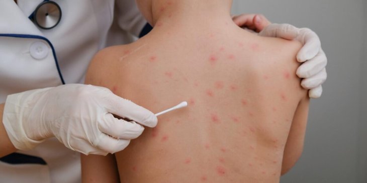 Харчова алергія: медики назвали симптоми та основні продукти, що провокують напад