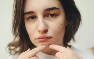 Що робити, якщо перед важливою подією на обличчі вискочив прищ?