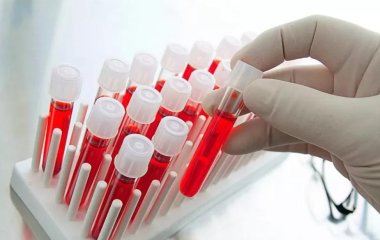 Вчені створили тест, який визначає пухлину мозку з 87% точністю