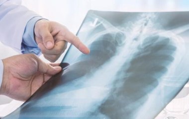 Лікарі описали несподіваний симптом раку легень