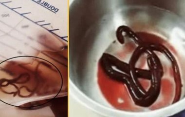 Чоловік, який не міг мочитися, був заражений одним із найбільших відомих людських паразитів — фото