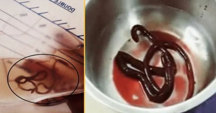 Чоловік, який не міг мочитися, був заражений одним із найбільших відомих людських паразитів — фото