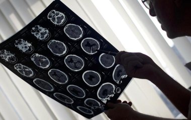 Японські вчені знайшли новий спосіб виявляти рак мозку