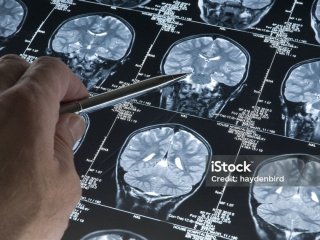 Невидима хвороба: чому мозок раптово починає атакувати тіло та викликає справжній параліч