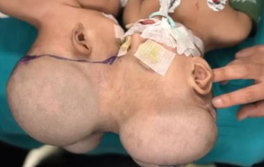 Сіамських близнючок зі спільною мозковою тканиною розділили під час ризикованої операції – фото