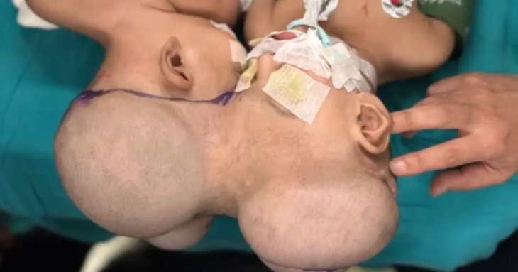 Сіамських близнючок зі спільною мозковою тканиною розділили під час ризикованої операції – фото