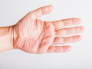Экзема на руках: причины и как с ней бороться