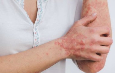 Медики назвали продукты, которые помогают при псориазе