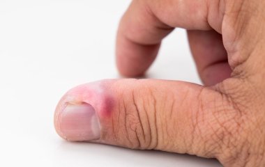 Гнійник біля нігтя: як лікувати та уникнути ускладнень