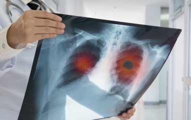 Лікар розповіли про помітні в різних частинах тіла симптоми раку легень