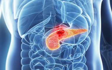 Медики назвали два нетипові симптоми раку підшлункової залози