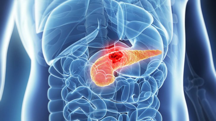 Медики назвали два нетипичных симптома рака поджелудочной железы