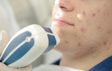 Як висвітлити постакне в домашніх умовах