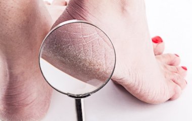 Суху шкіру на ногах вчені пов'язали із ознакою високого холестерину
