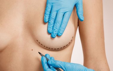 Які питання варто поставити лікарю клініки MED CITY до операції збільшення грудей?
