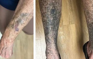 Руки та ноги жінки стали синьо-сірими через популярний антибіотик — фото