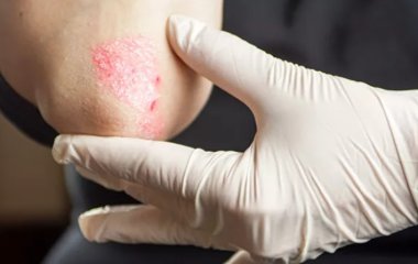 Чим небезпечний псоріаз: лікар розповів про причини та лікування хвороби