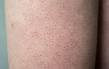 Чому руки взимку вкриваються червоними горбиками: лікарка назвала справжню причину