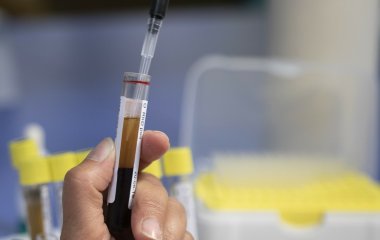 Лікар перерахувала чотири ознаки високого холестерину