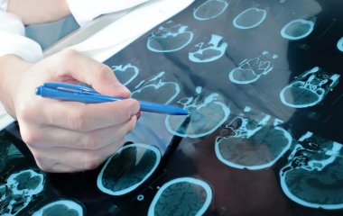 Врач назвал заболевания, на которые может указывать ухудшение памяти