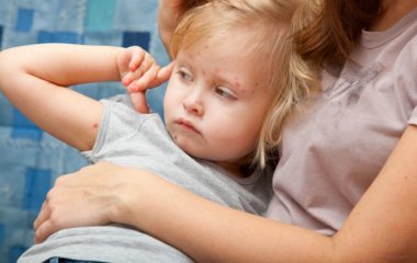 Кір: симптоми, профілактика та лікування хвороби