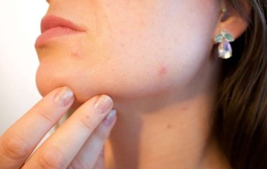 Опоясывающий лишай: медики назвали два первых признака опасной инфекции