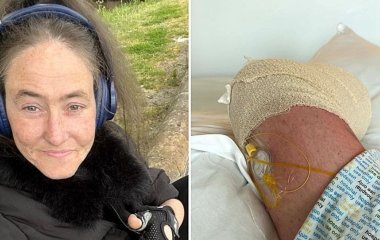 Жінці ампутували ногу після того, як вона наступила на собачий корм (фото)