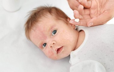 Атопічний дерматит у дітей: симптоми, методи лікування та рятівна профілактика