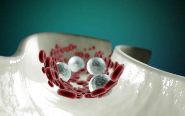 Медики рассказали, как предотвратить закупорку артерий