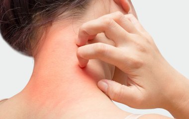 Сильна сверблячка може вказувати на рак