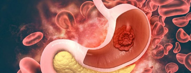Методи лікування метастатичного раку шлунка