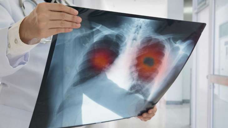 Рак легких: 5 неожиданных симптомов опасного заболевания