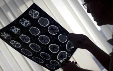 Вчені з'ясували роль зв'язку між спинним та головним мозком у наслідках інсульту