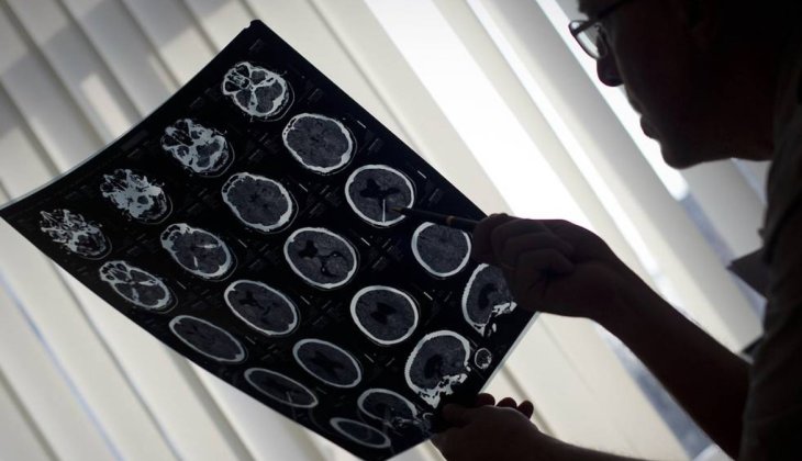 Вчені з'ясували роль зв'язку між спинним та головним мозком у наслідках інсульту