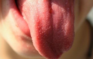 Пожежа у животі. Кислий смак у роті – симптом хвороби