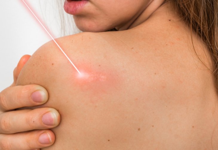 Вірусні бородавки як позбавитися швидко і правильно