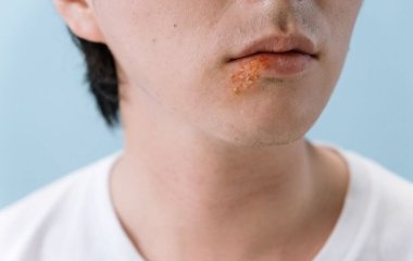 Як позбутися герпесу за допомогою домашніх засобів