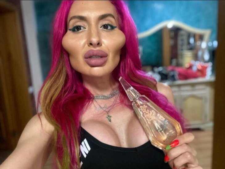 Украинка с самыми большими скулами в мире вновь легла под нож: что увеличила на этот раз