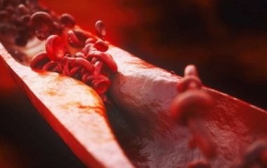 Симптом, который указывает на то, что в крови зашкаливает холестерин назвали врачи