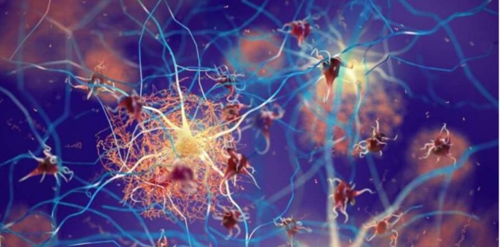 Ученые обнаружили новую причину болезни Альцгеймера и БАС