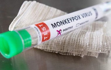 Лікар попередив про можливість безсимптомного перебігу віспи мавп