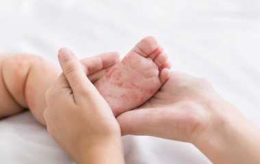 Імунолог перерахував фактори, що впливають на розвиток алергії у дітей