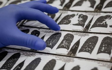 Ученые рассказали о меньшем вреде «Омикрона» для легких