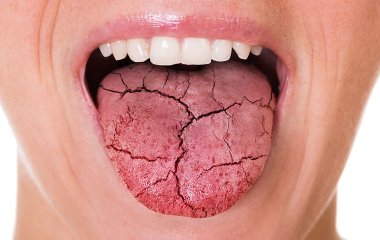 Сухость во рту: о каких заболеваниях это может свидетельствовать