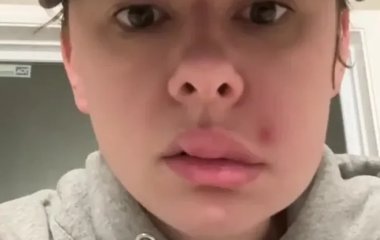 Видавлений прищ ледь не коштував здоров’я: що сталося з обличчям дівчини