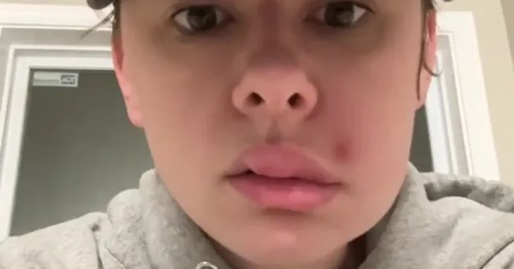 Видавлений прищ ледь не коштував здоров’я: що сталося з обличчям дівчини