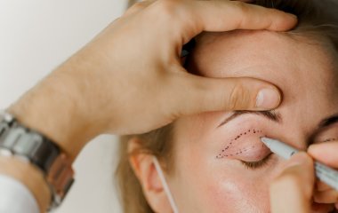 Хірург назвав 8 ускладнень після блефаропластики та прості способи їх уникнути