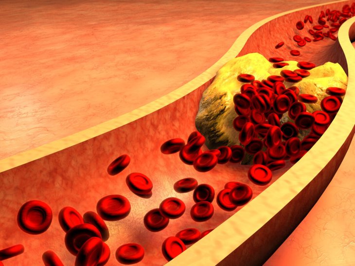 5 проверенных способов снизить высокий уровень холестерина в организме
